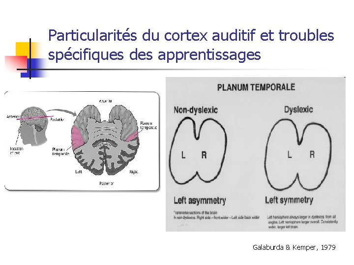 Particularités du cortex auditif et troubles spécifiques des apprentissages Galaburda & Kemper, 1979 