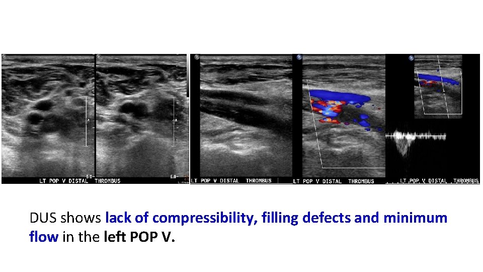 DUS shows lack of compressibility, filling defects and minimum flow in the left POP