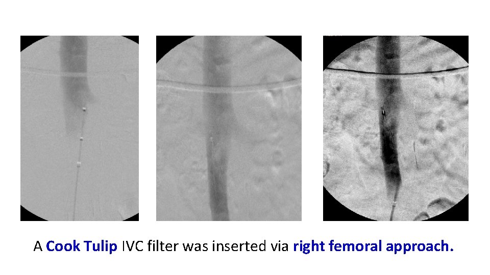 A Cook Tulip IVC filter was inserted via right femoral approach. 