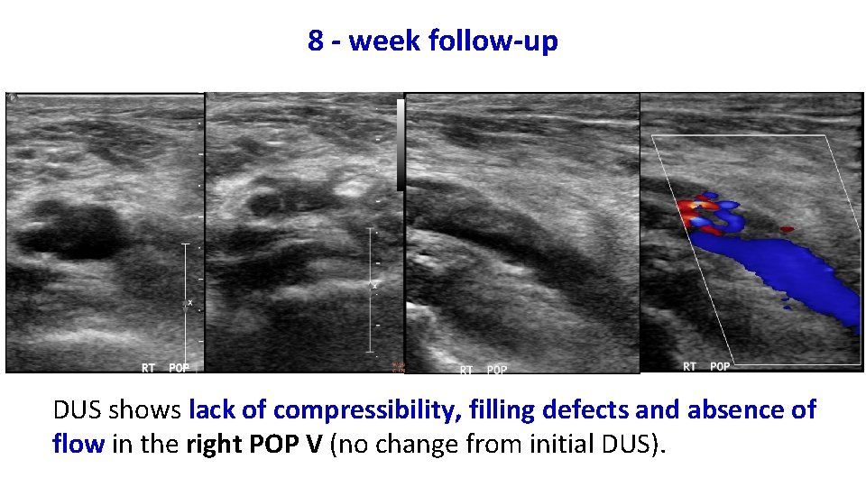 8 - week follow-up DUS shows lack of compressibility, filling defects and absence of