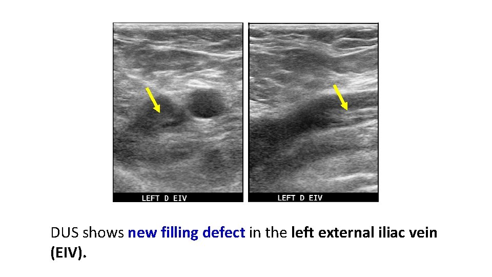 DUS shows new filling defect in the left external iliac vein (EIV). 