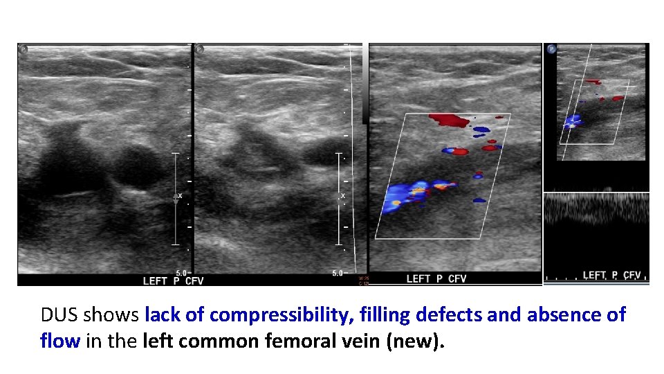 DUS shows lack of compressibility, filling defects and absence of flow in the left