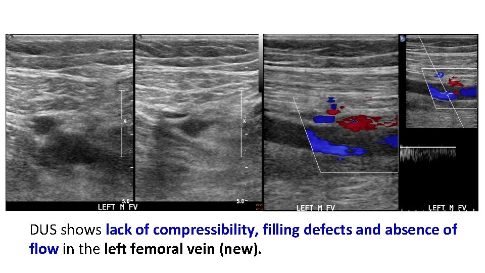 DUS shows lack of compressibility, filling defects and absence of flow in the left