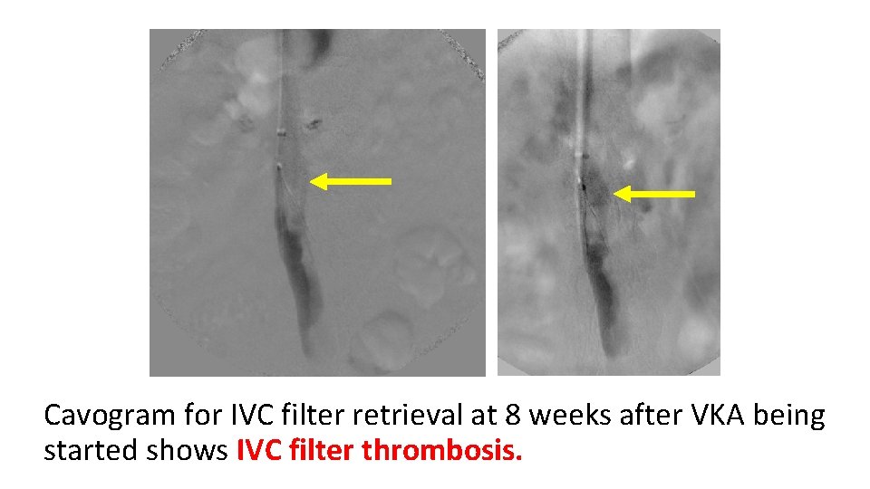 Cavogram for IVC filter retrieval at 8 weeks after VKA being started shows IVC