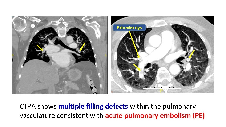 Polo mint sign CTPA shows multiple filling defects within the pulmonary vasculature consistent with
