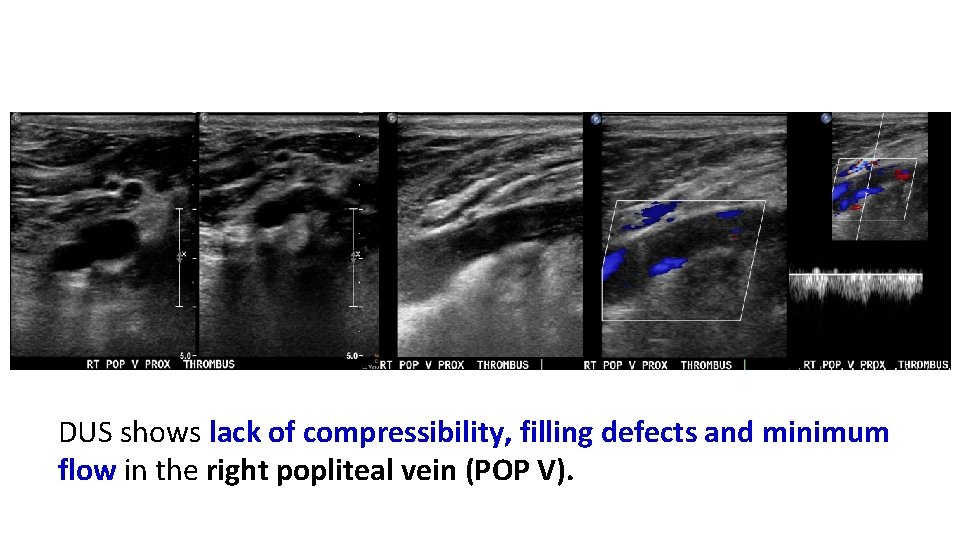 DUS shows lack of compressibility, filling defects and minimum flow in the right popliteal