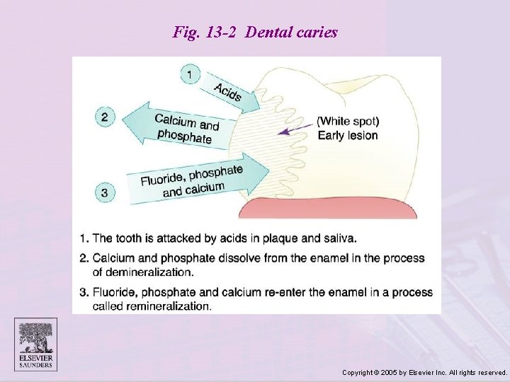 Fig. 13 -2 Dental caries Copyright © 2005 by Elsevier Inc. All rights reserved.