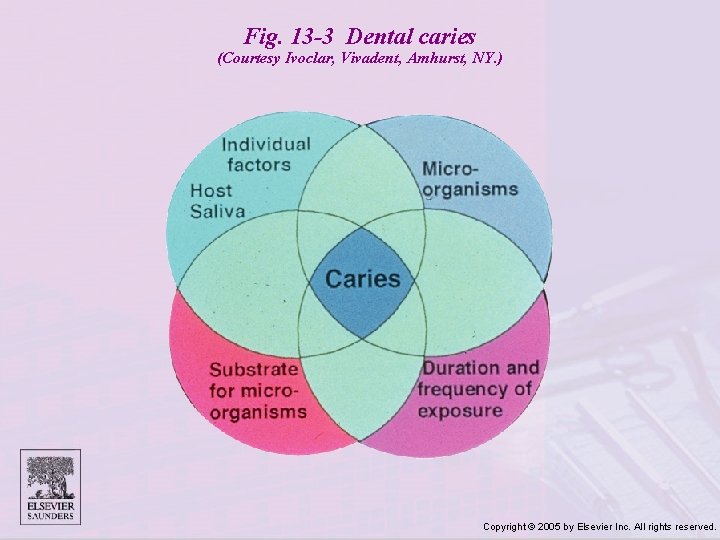 Fig. 13 -3 Dental caries (Courtesy Ivoclar, Vivadent, Amhurst, NY. ) Copyright © 2005