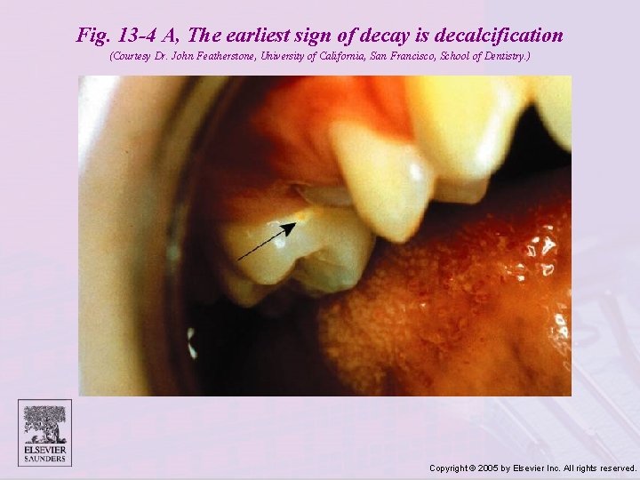 Fig. 13 -4 A, The earliest sign of decay is decalcification (Courtesy Dr. John