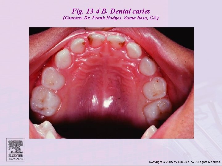 Fig. 13 -4 B, Dental caries (Courtesy Dr. Frank Hodges, Santa Rosa, CA. )