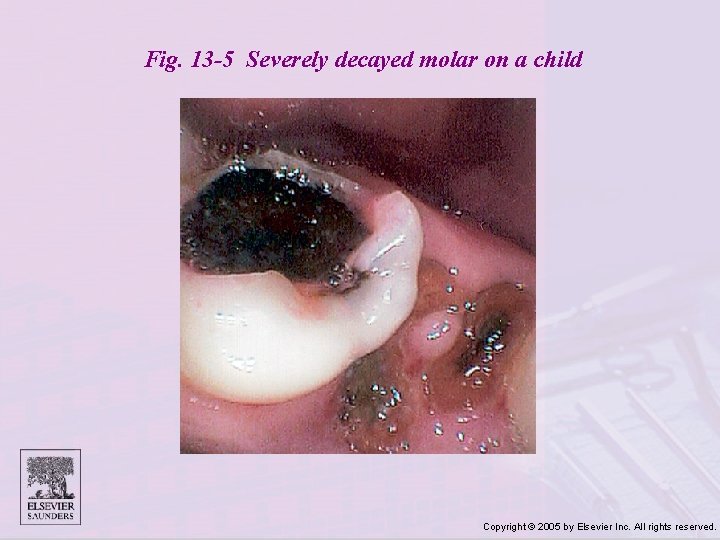 Fig. 13 -5 Severely decayed molar on a child Copyright © 2005 by Elsevier