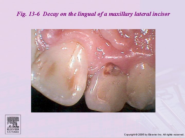 Fig. 13 -6 Decay on the lingual of a maxillary lateral incisor Copyright ©