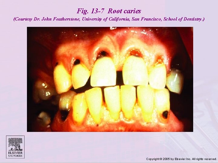 Fig. 13 -7 Root caries (Courtesy Dr. John Featherstone, University of California, San Francisco,