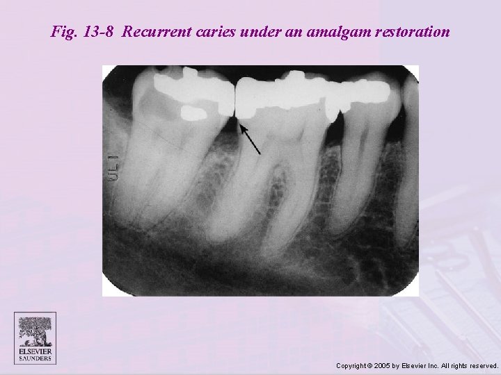Fig. 13 -8 Recurrent caries under an amalgam restoration Copyright © 2005 by Elsevier