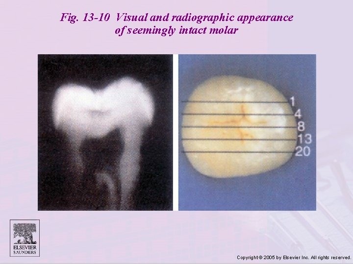 Fig. 13 -10 Visual and radiographic appearance of seemingly intact molar Copyright © 2005