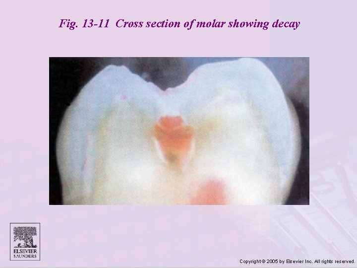 Fig. 13 -11 Cross section of molar showing decay Copyright © 2005 by Elsevier