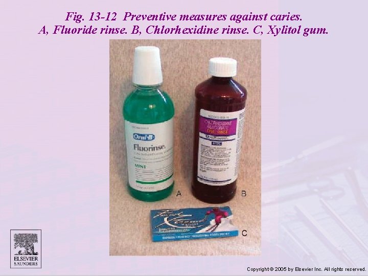 Fig. 13 -12 Preventive measures against caries. A, Fluoride rinse. B, Chlorhexidine rinse. C,