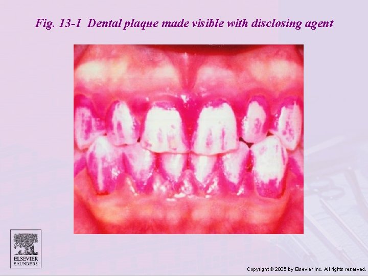 Fig. 13 -1 Dental plaque made visible with disclosing agent Copyright © 2005 by