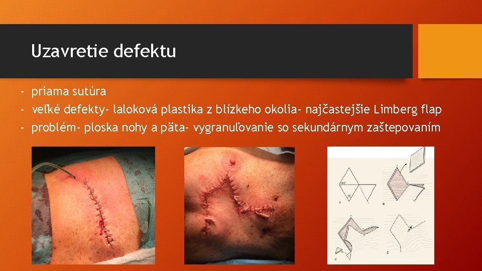 Uzavretie defektu - priama sutúra - veľké defekty- laloková plastika z blízkeho okolia- najčastejšie