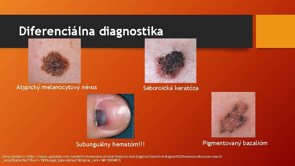 Diferenciálna diagnostika Atypický melanocytový névus Seboroická keratóza Subunguálny hematóm!!! Pigmentovaný bazalióm Zdroj obrázkov: https: