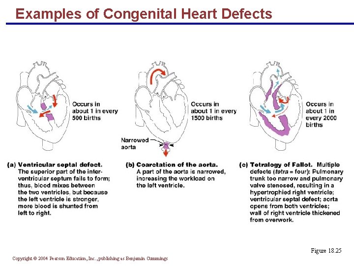 Examples of Congenital Heart Defects Figure 18. 25 Copyright © 2004 Pearson Education, Inc.