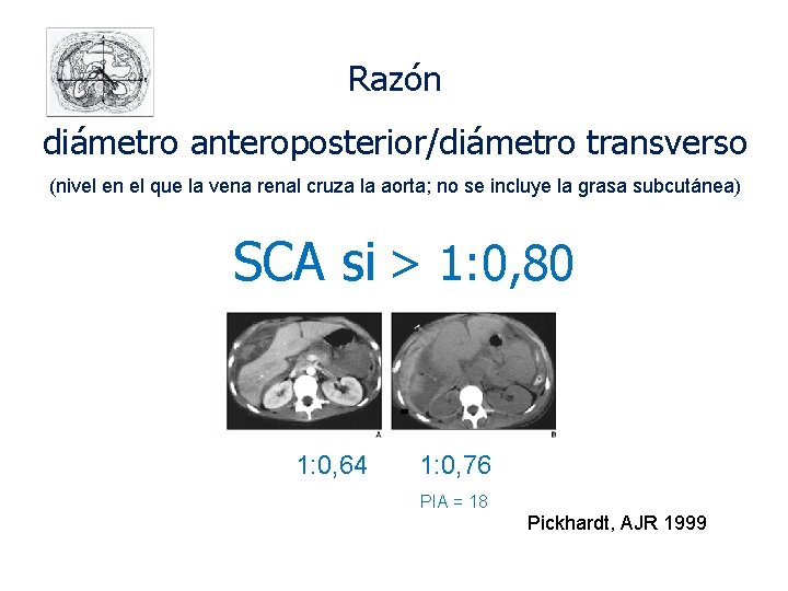Razón diámetro anteroposterior/diámetro transverso (nivel en el que la vena renal cruza la aorta;