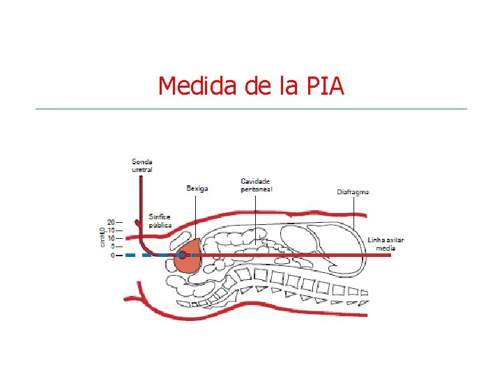 Medida de la PIA 