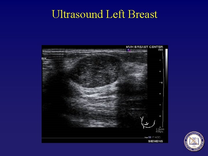 Ultrasound Left Breast 