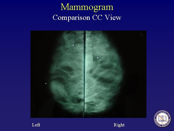 Mammogram Comparison CC View Left Right 