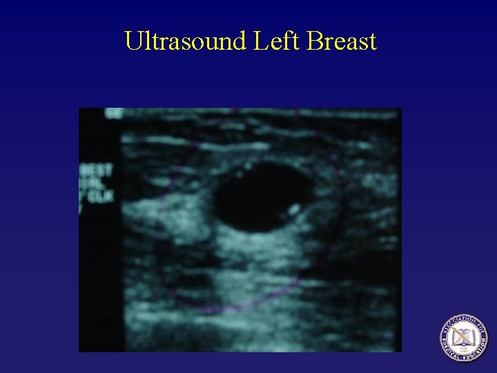 Ultrasound Left Breast 