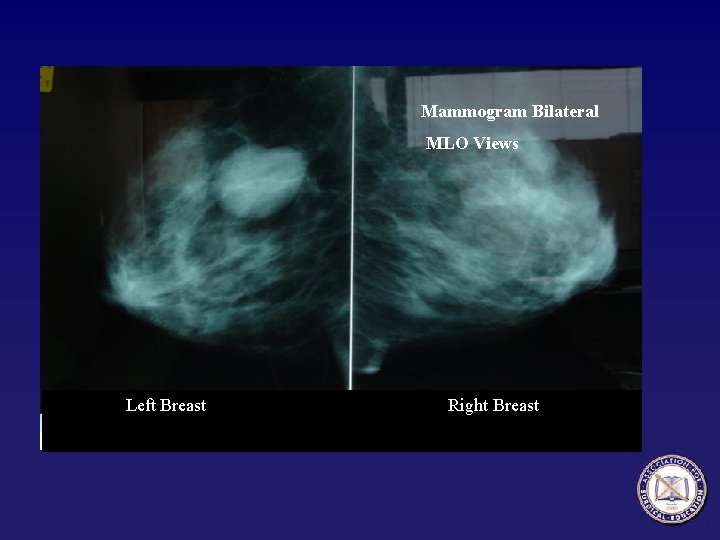 Mammogram Bilateral MLO Views Left Breast Right Breast 