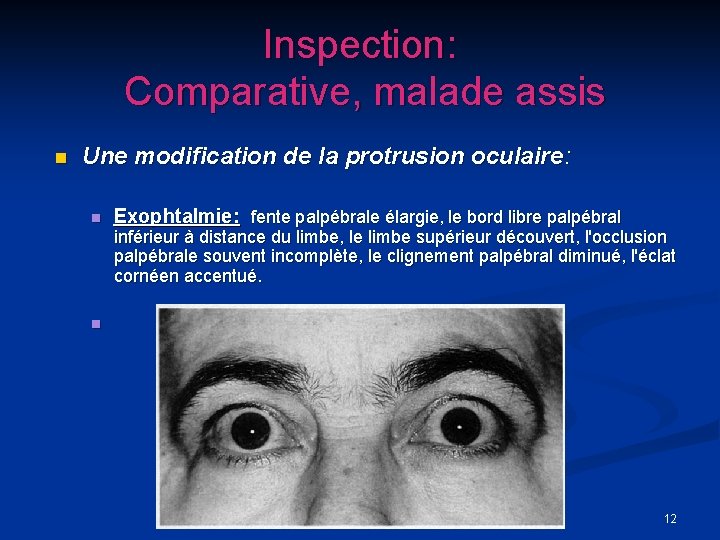 Inspection: Comparative, malade assis n Une modification de la protrusion oculaire: n Exophtalmie: fente