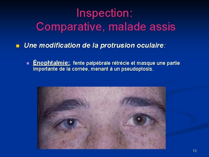 Inspection: Comparative, malade assis n Une modification de la protrusion oculaire: n Énophtalmie: .