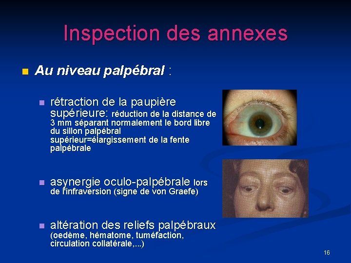Inspection des annexes n Au niveau palpébral : n rétraction de la paupière supérieure: