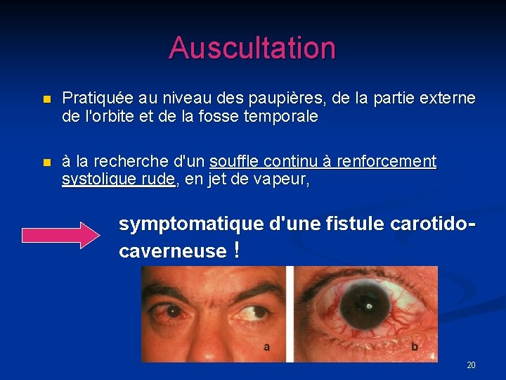 Auscultation n Pratiquée au niveau des paupières, de la partie externe de l'orbite et