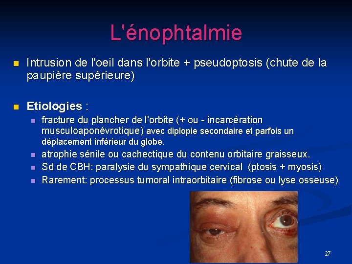 L'énophtalmie n Intrusion de l'oeil dans l'orbite + pseudoptosis (chute de la paupière supérieure)