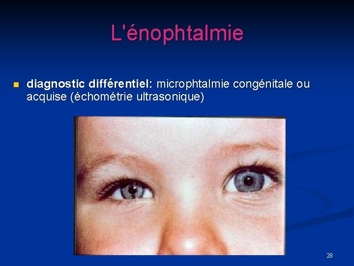 L'énophtalmie n diagnostic différentiel: microphtalmie congénitale ou acquise (échométrie ultrasonique) 28 
