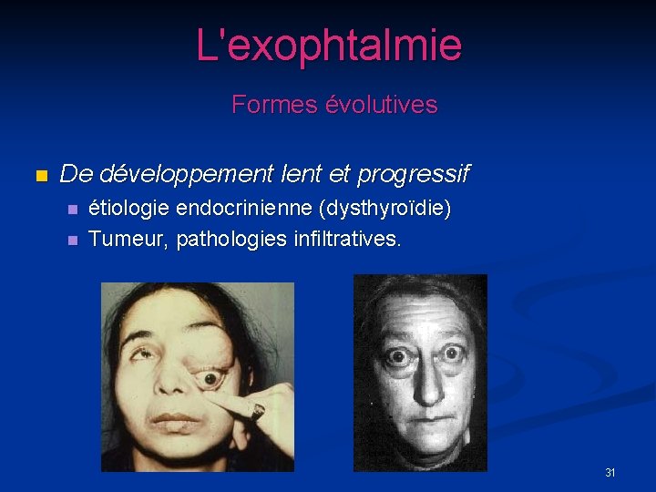 L'exophtalmie Formes évolutives n De développement lent et progressif n n étiologie endocrinienne (dysthyroïdie)