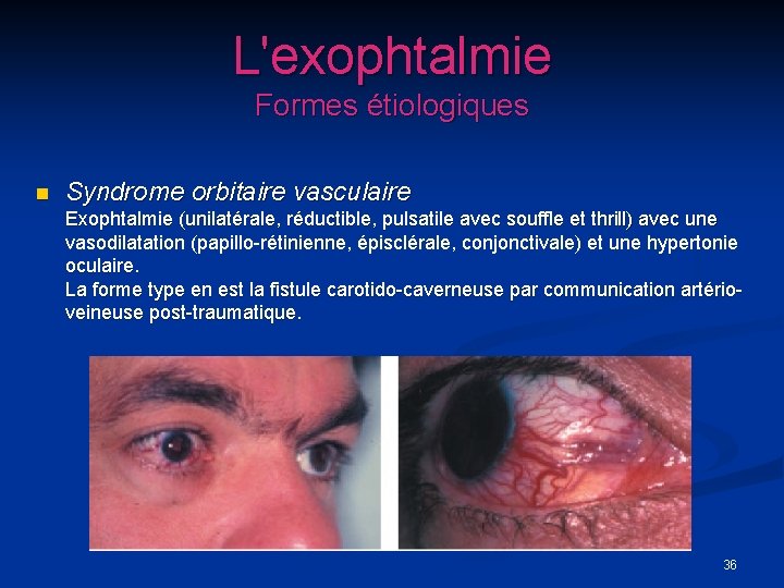 L'exophtalmie Formes étiologiques n Syndrome orbitaire vasculaire Exophtalmie (unilatérale, réductible, pulsatile avec souffle et