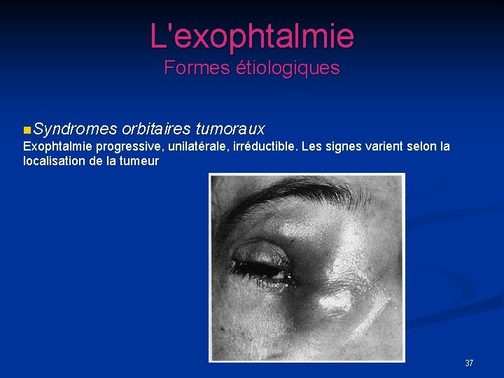 L'exophtalmie Formes étiologiques n. Syndromes orbitaires tumoraux Exophtalmie progressive, unilatérale, irréductible. Les signes varient