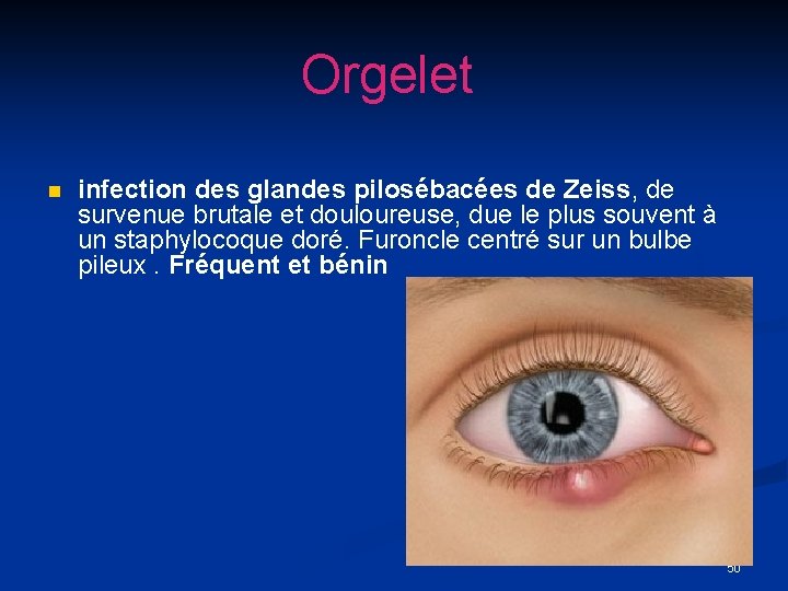 Orgelet n infection des glandes pilosébacées de Zeiss, de survenue brutale et douloureuse, due