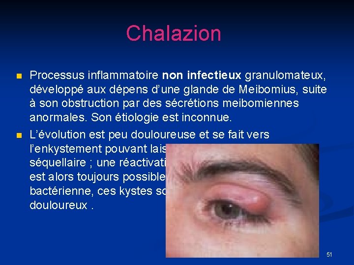 Chalazion n n Processus inflammatoire non infectieux granulomateux, développé aux dépens d’une glande de