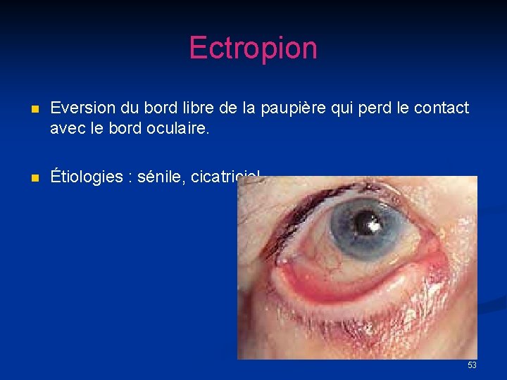 Ectropion n Eversion du bord libre de la paupière qui perd le contact avec