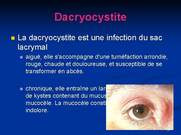 Dacryocystite n La dacryocystite est une infection du sac lacrymal n aiguë, elle s'accompagne