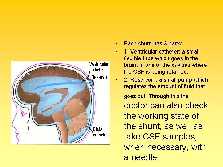  • • • Each shunt has 3 parts: 1 - Ventricular catheter: a