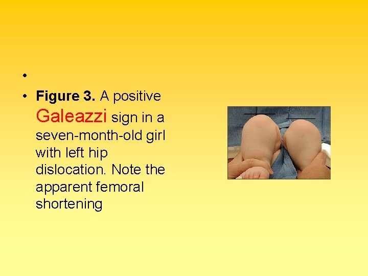  • • Figure 3. A positive Galeazzi sign in a seven-month-old girl with