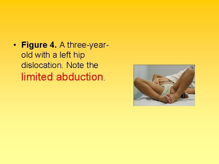  • Figure 4. A three-yearold with a left hip dislocation. Note the limited