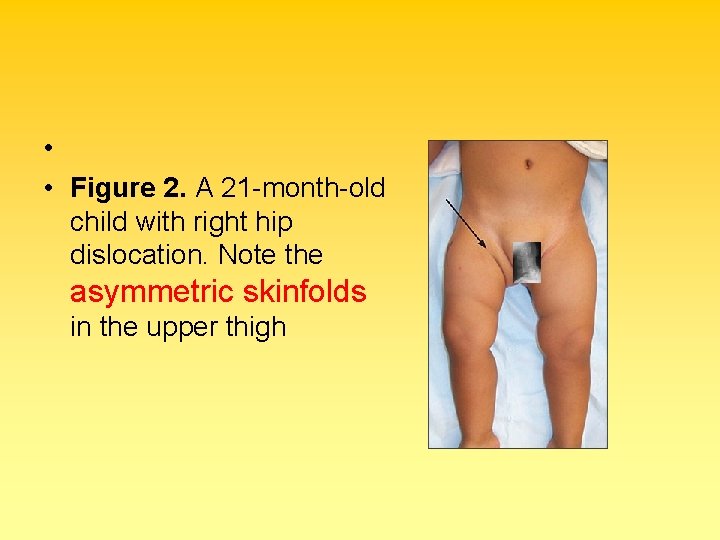  • • Figure 2. A 21 -month-old child with right hip dislocation. Note