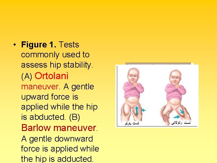  • Figure 1. Tests commonly used to assess hip stability. (A) Ortolani maneuver.
