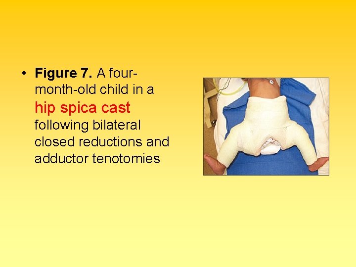  • Figure 7. A fourmonth-old child in a hip spica cast following bilateral